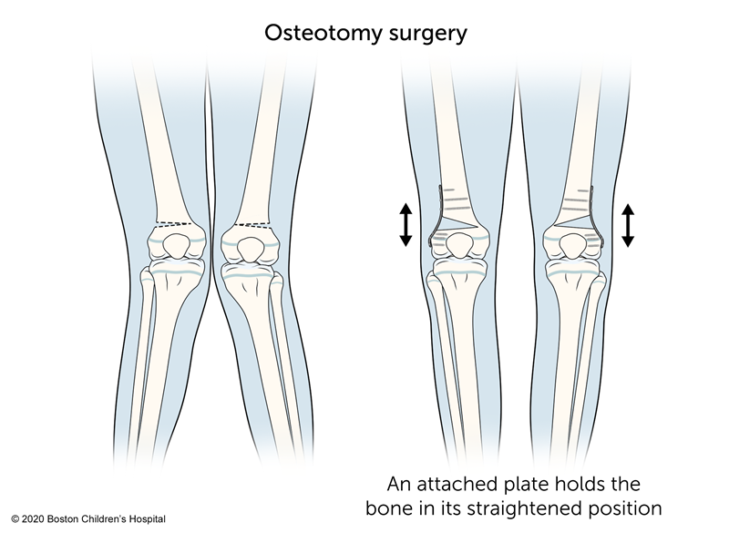 Knock Knee Osteotomy